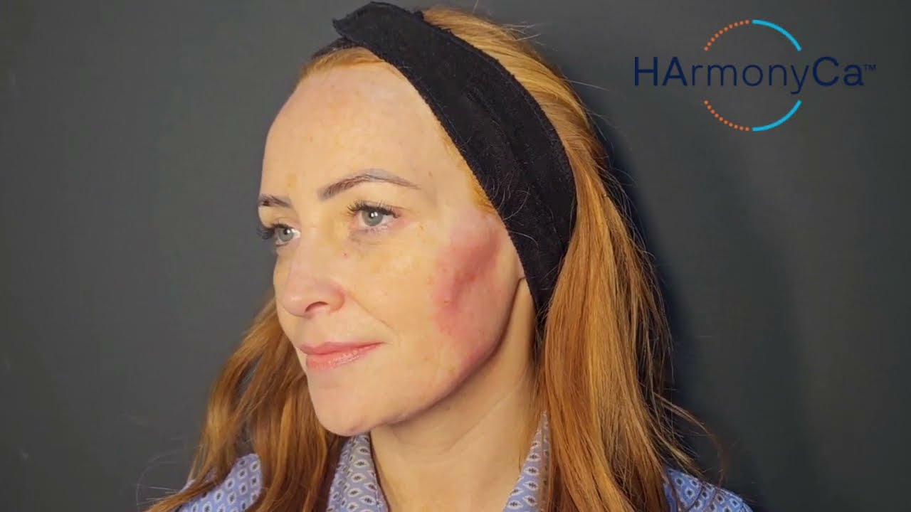 HarmonycA - The first hybrid injectable!