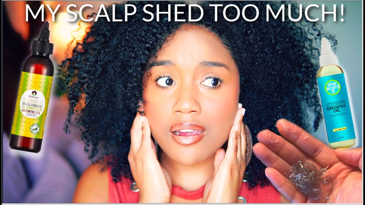 How I Accidentally JACKED UP My Scalp l Excessive Shedding Without Irritation + Treatment Plan