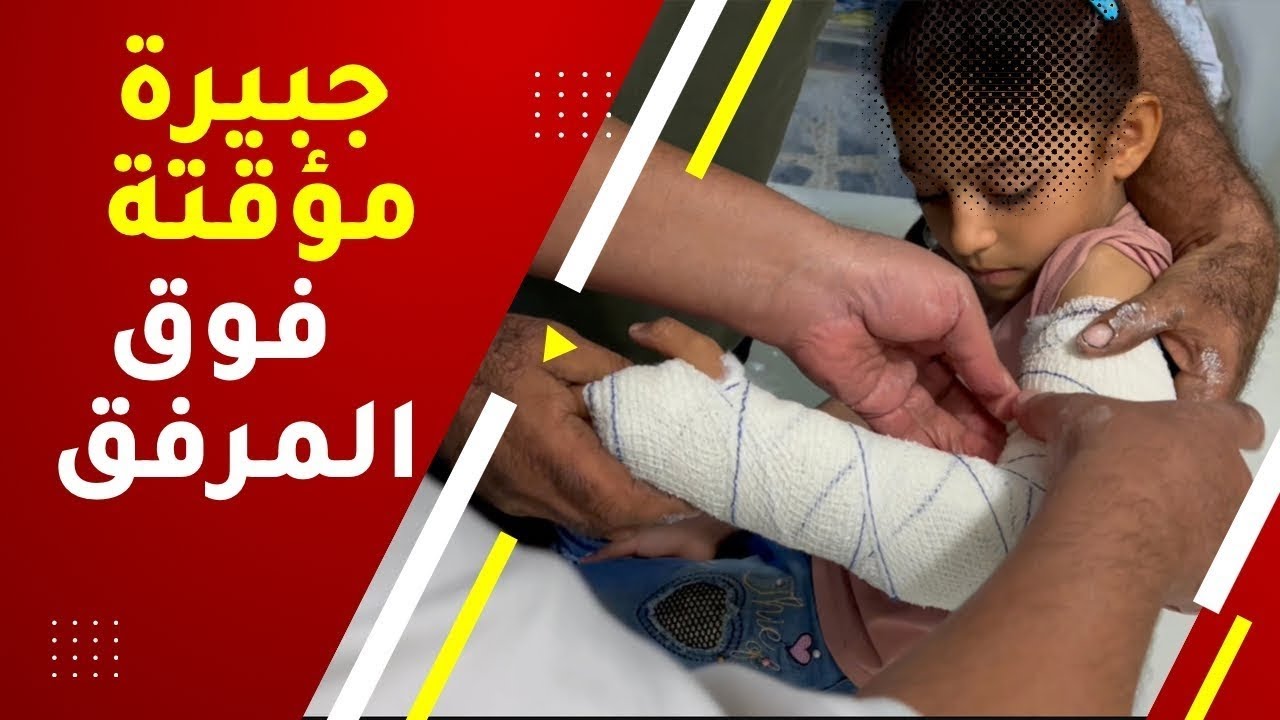 جبيرة كسر عظم الزند فوق المرفق