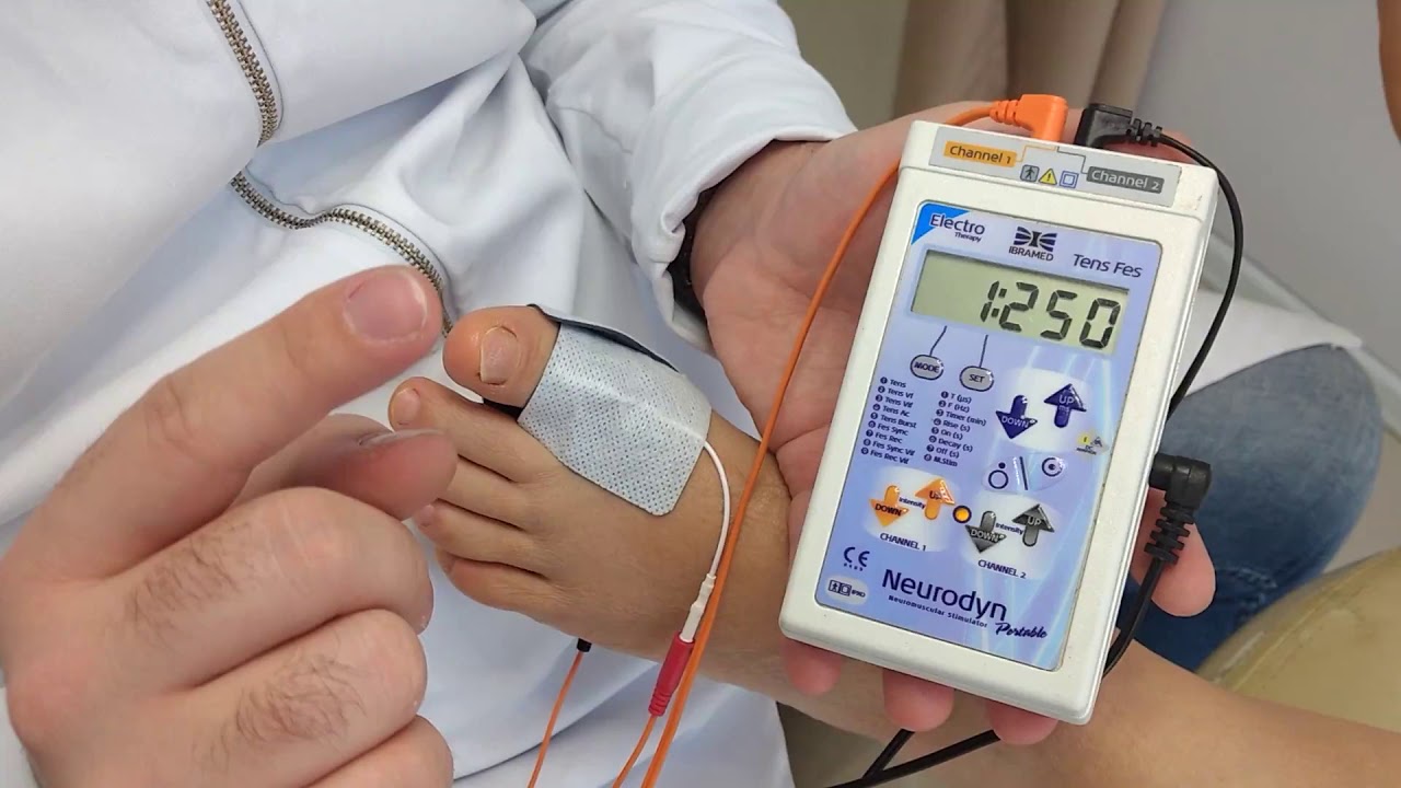 TENS - para analgesia em onicocriptose