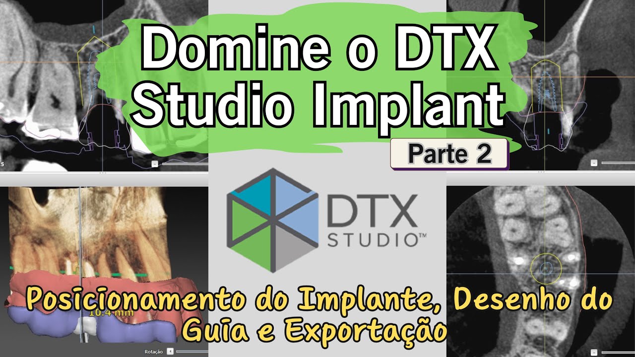 Passo a passo no DTX Studio Implant: Smart setup, posição do implante, confecção e download do guia