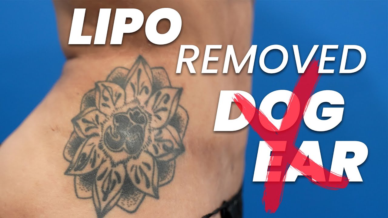 Can "Dog Ears" from a Tummy Tuck Be Removed?