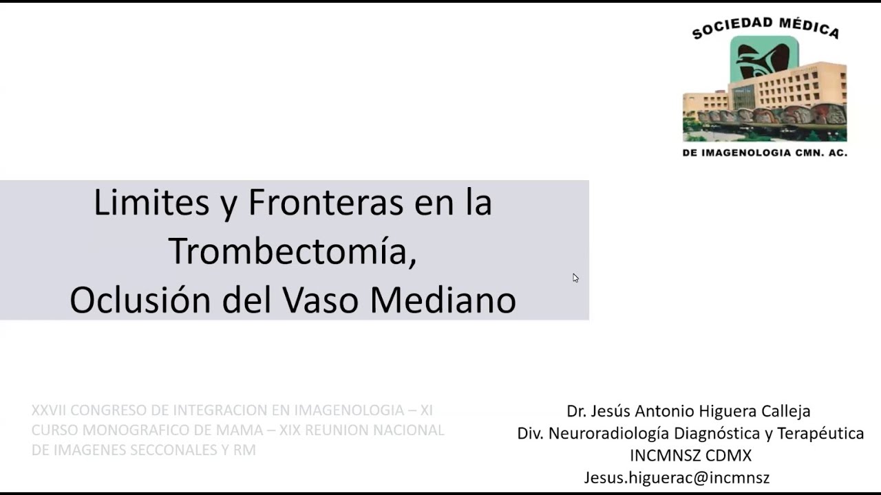 3 - 9 Trombectomía en mediano vaso | Dr. Jesús Higuera