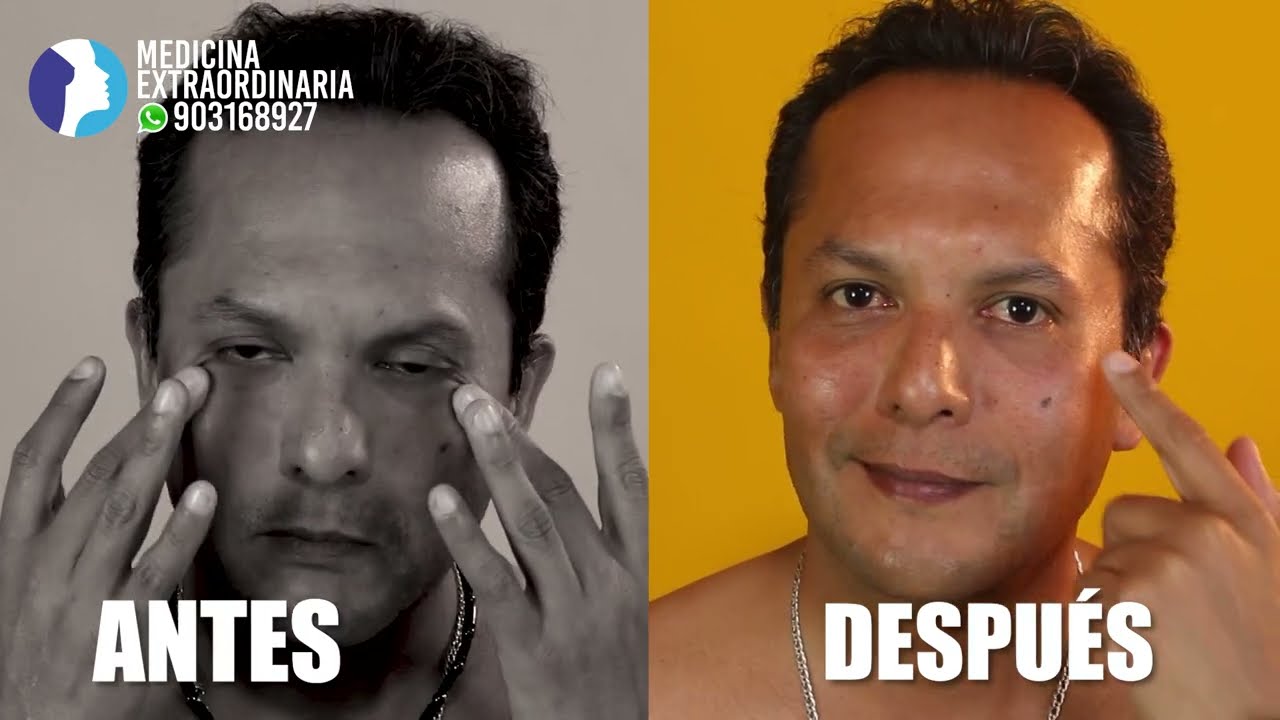 LIPOMARCACIÓN de IMPACTO Hombres💙 Mira AQUÍ Resultados Naturales 🔥 Dr PERCY NEVADO Cirugía Plástica