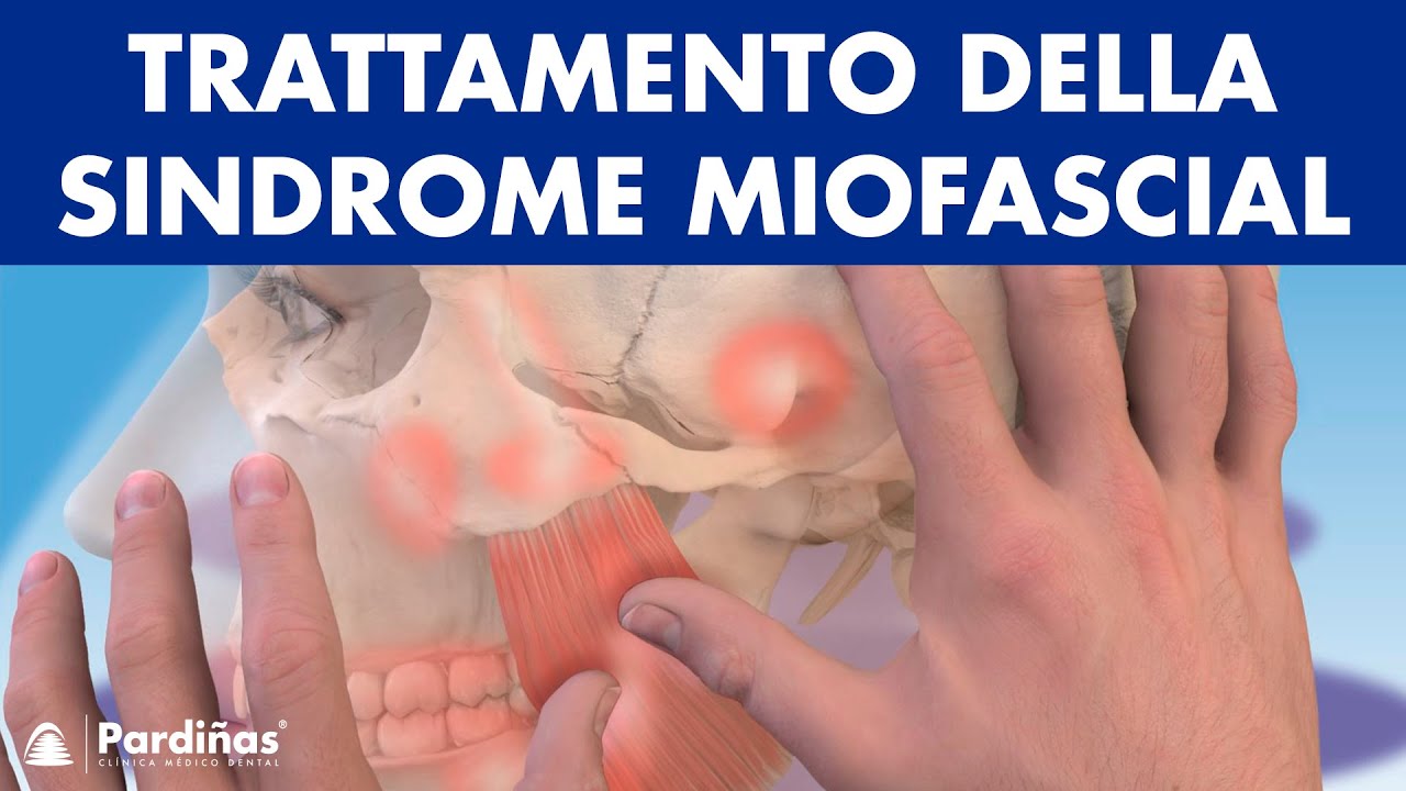Trattamento della SINDROME MIOFASCIALE - Come allevarie i PUNTI TRIGGER con la fisioterapia ©