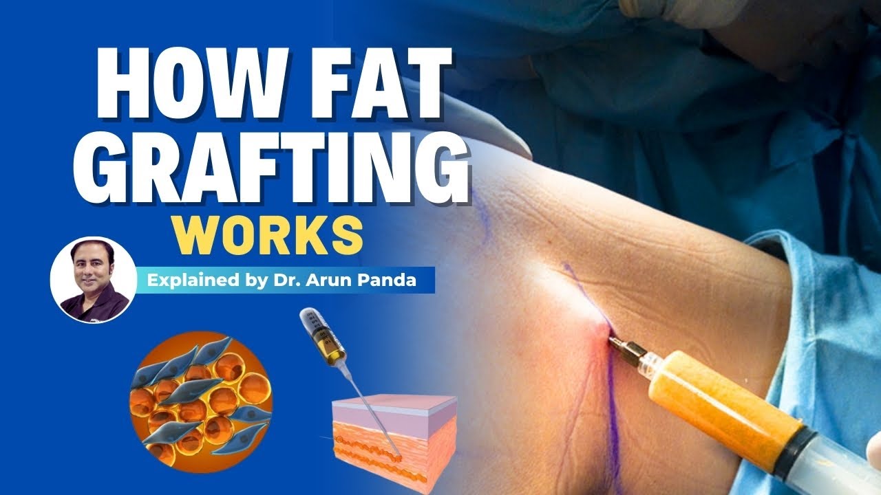 How Fat Grafting Works Explained by Dr Arun Panda | Trinity Aesthetics Academy