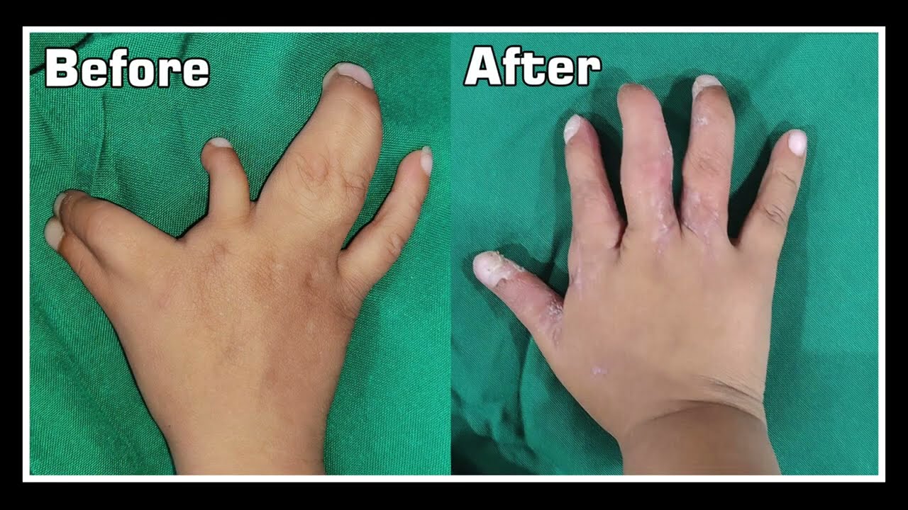 जुड़ी हुई उंगलियों का इलाज: बच्चों में सिंडक्टिली की प्लास्टिक सर्जरी | Dr. Dilip Variya