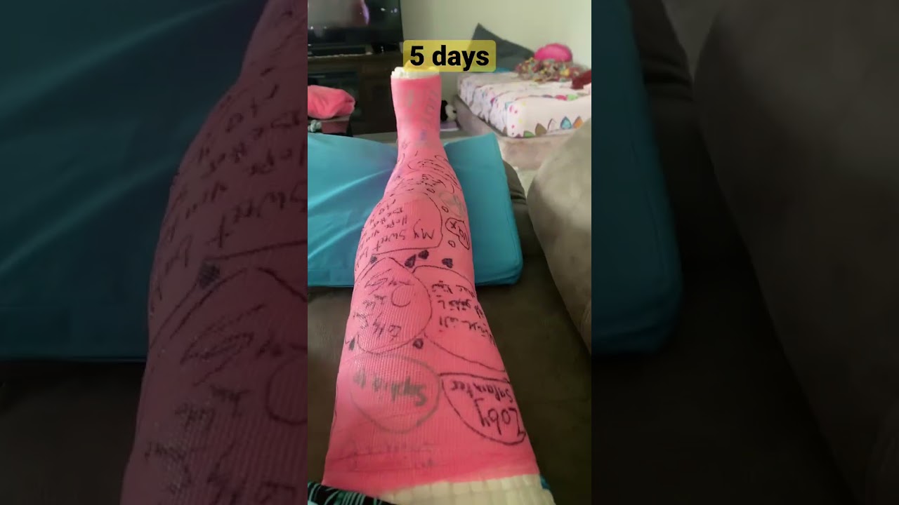 The journey of my full leg cast removal.