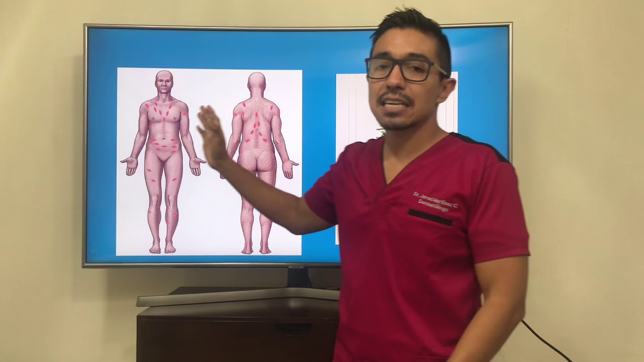 Pitiriasis rosada