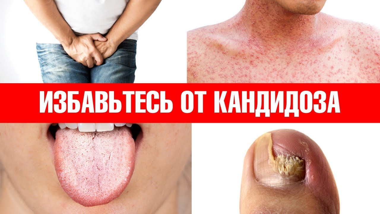 Примените эти 6 средств, и кандидоз никогда не вернется👍