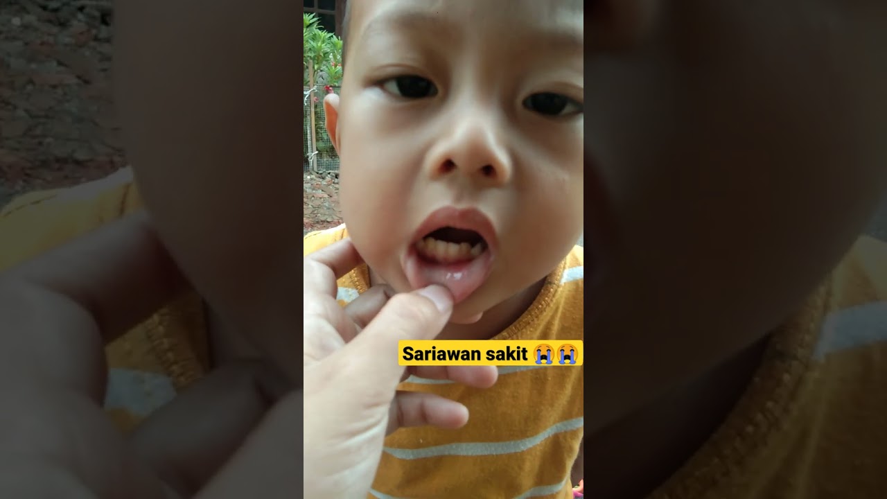 Gak Mau Makan, Bibir Sakit Sariawan 😭😭