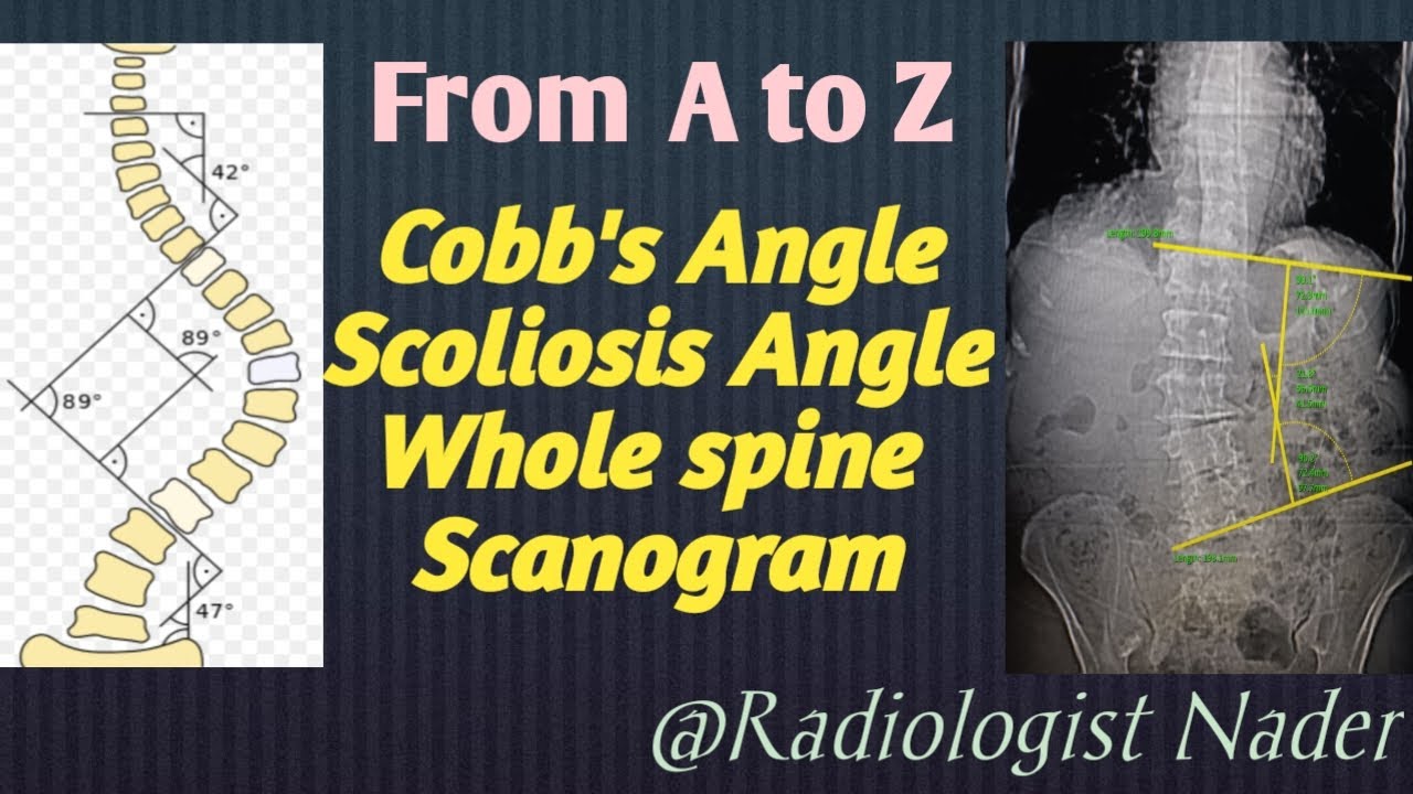 قياس زاوية اعوجاج العمود الفقري|جهاز مقطعية فيليبس|Cobb's(Scoliosis)Angle
