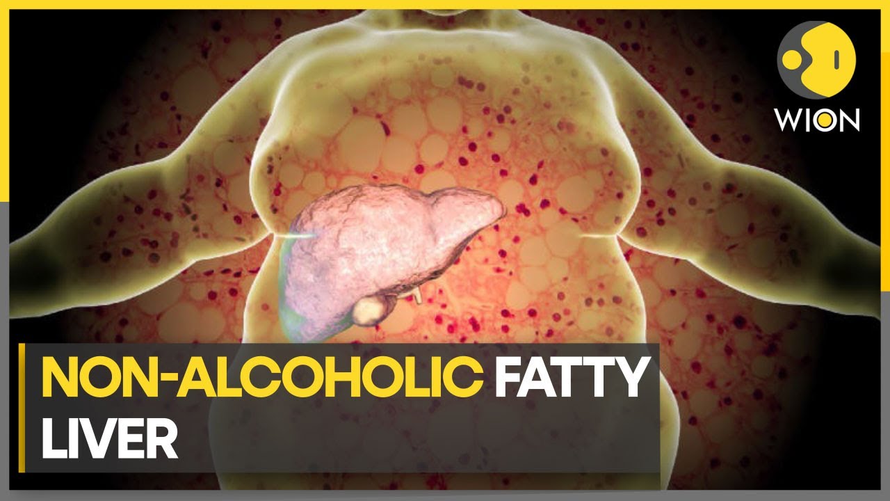 Unhealthy eating habits & lifestyle can cause fatty liver | World News | WION