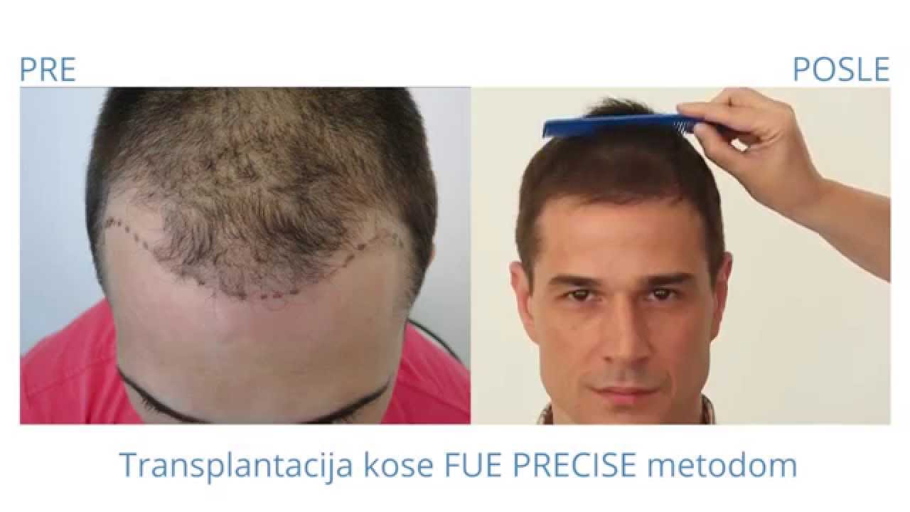 Transplantacija kose - dr Marija Balković