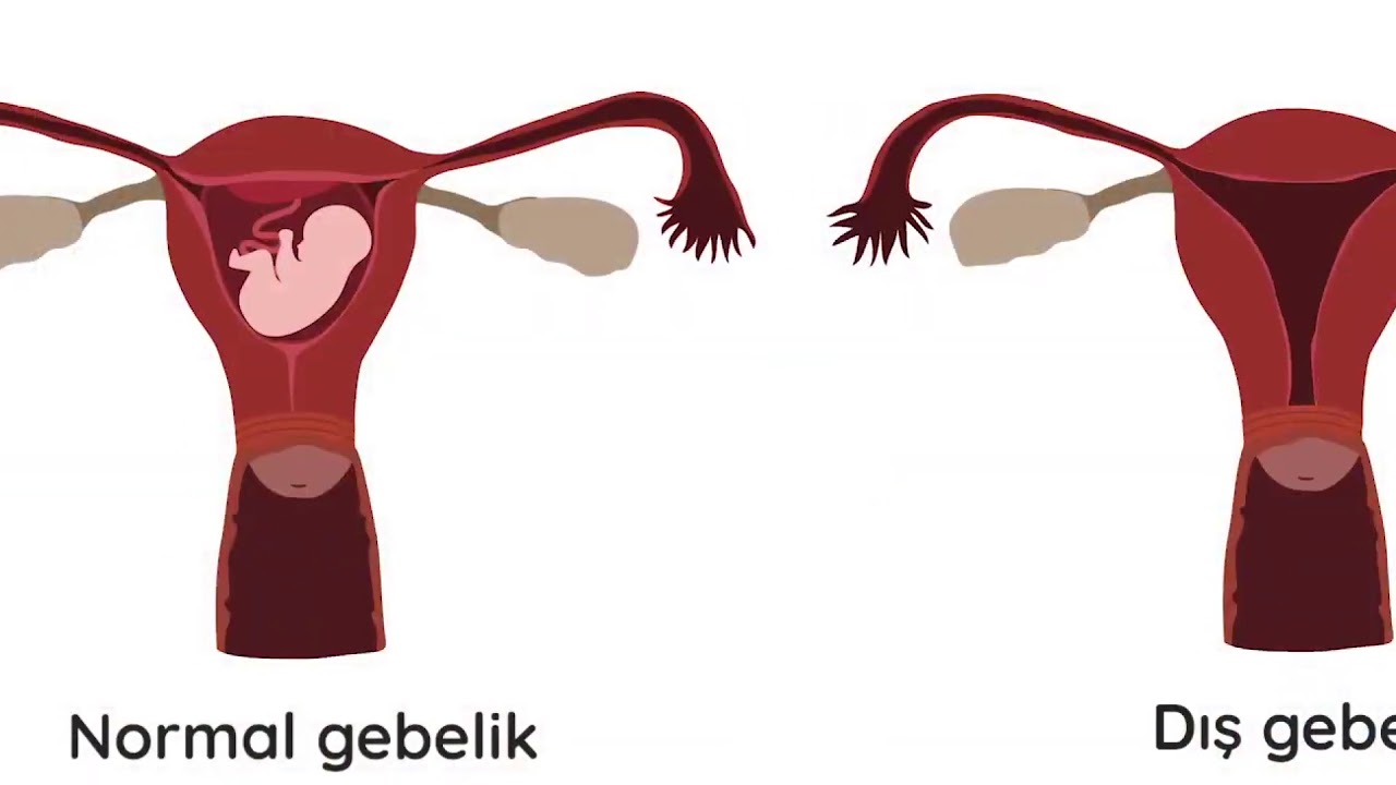 Dış Gebelik - Op. Dr Yunus Çavuş