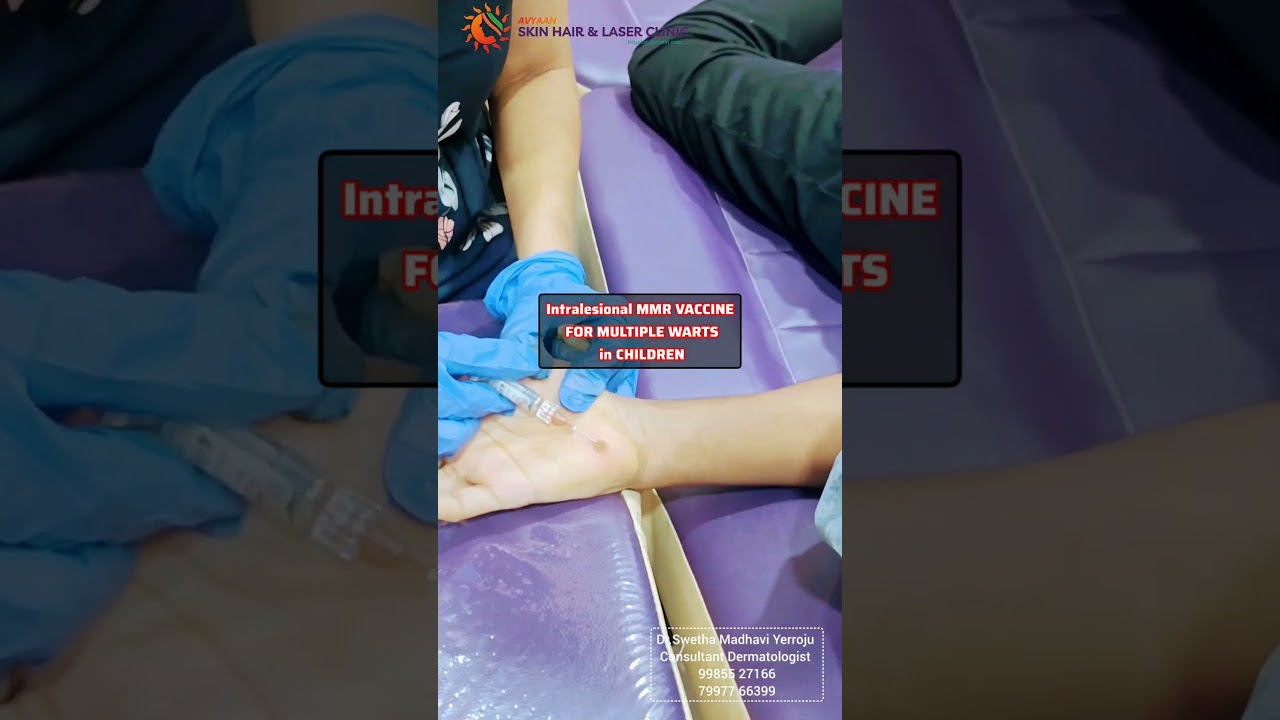 INTRALESIONAL MMR VACCINE FOR MULTIPLE WARTS IN CHILDREN #drswethamadhaviyerroju #vizag