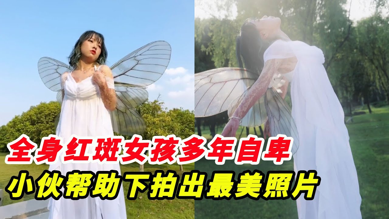 全身紅斑女孩多年自卑生活艱難！小夥幫忙拍出最美照片，震撼全網！