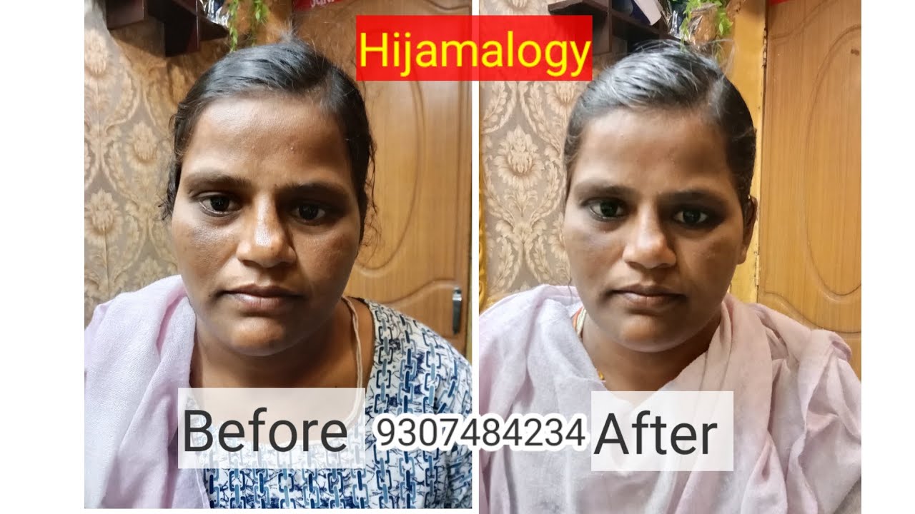 Cupping in Nagpur all type of pain diseases AVN  issues, SUCCESSFULLY TREATED