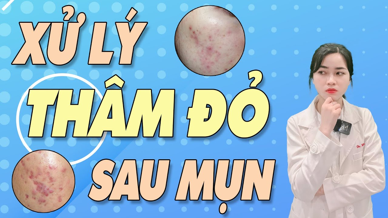 THÂM ĐỎ SAU MỤN - Bí quyết xử lý thâm đỏ hiệu quả|Bs Nguyễn Ngọc