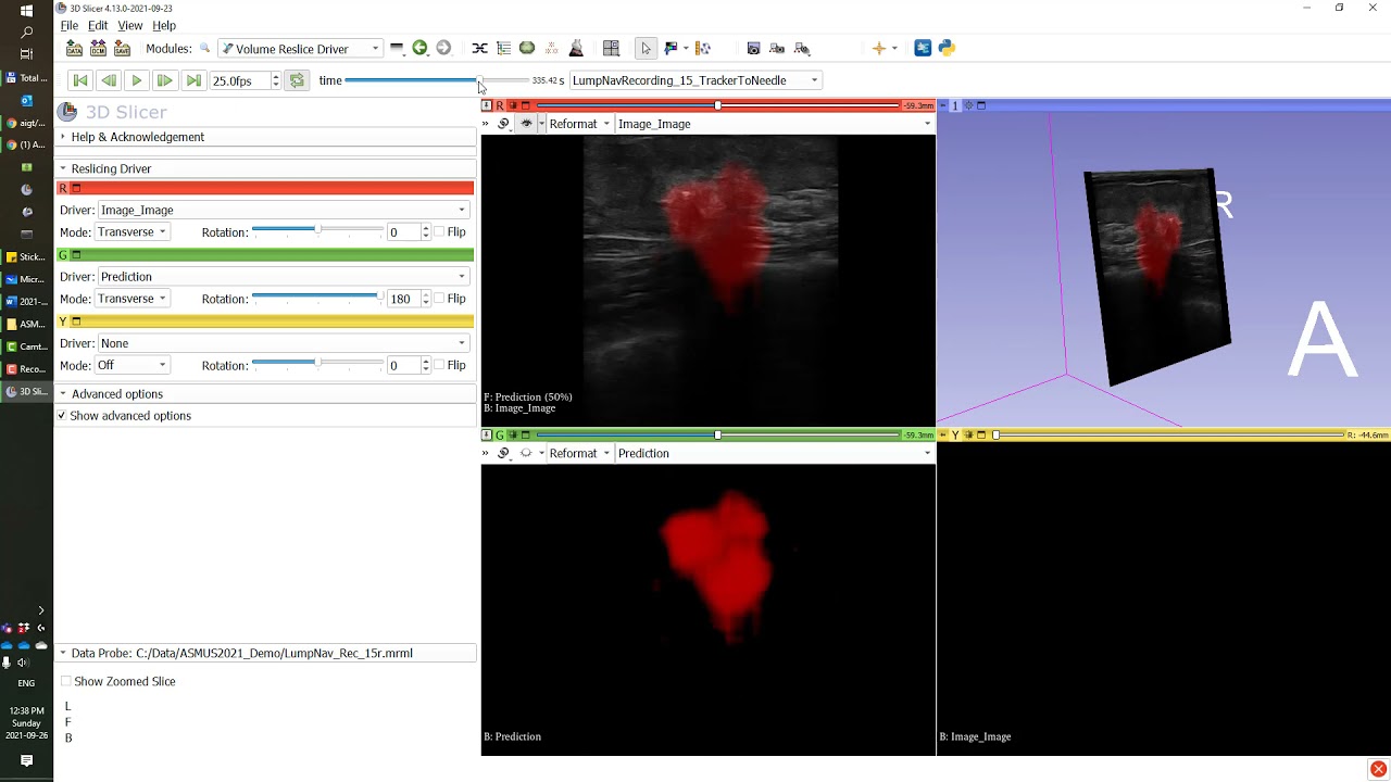 Real-time ultrasound AI segmentation and volume reconstruction