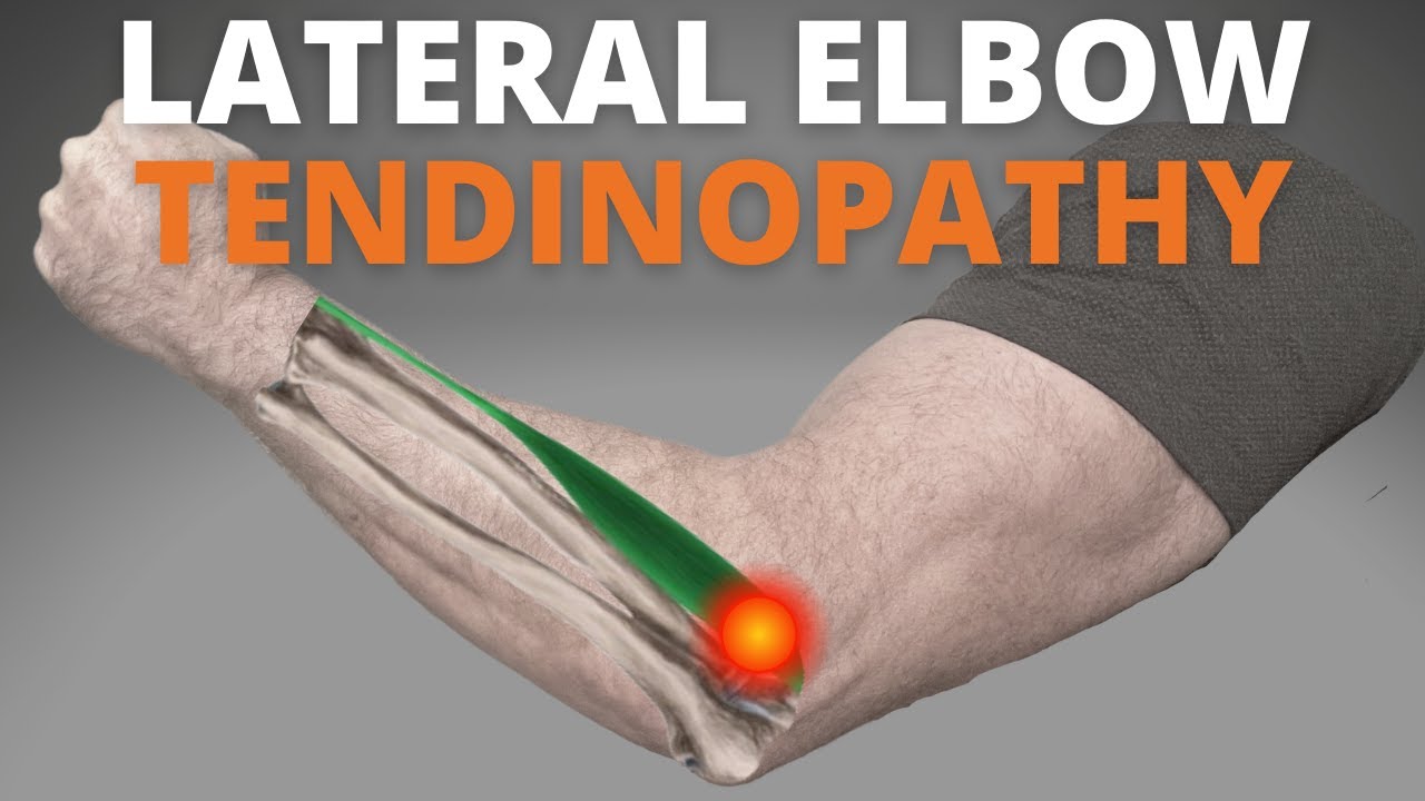 Lateral Elbow Tendinopathy (REHAB EXERCISES)