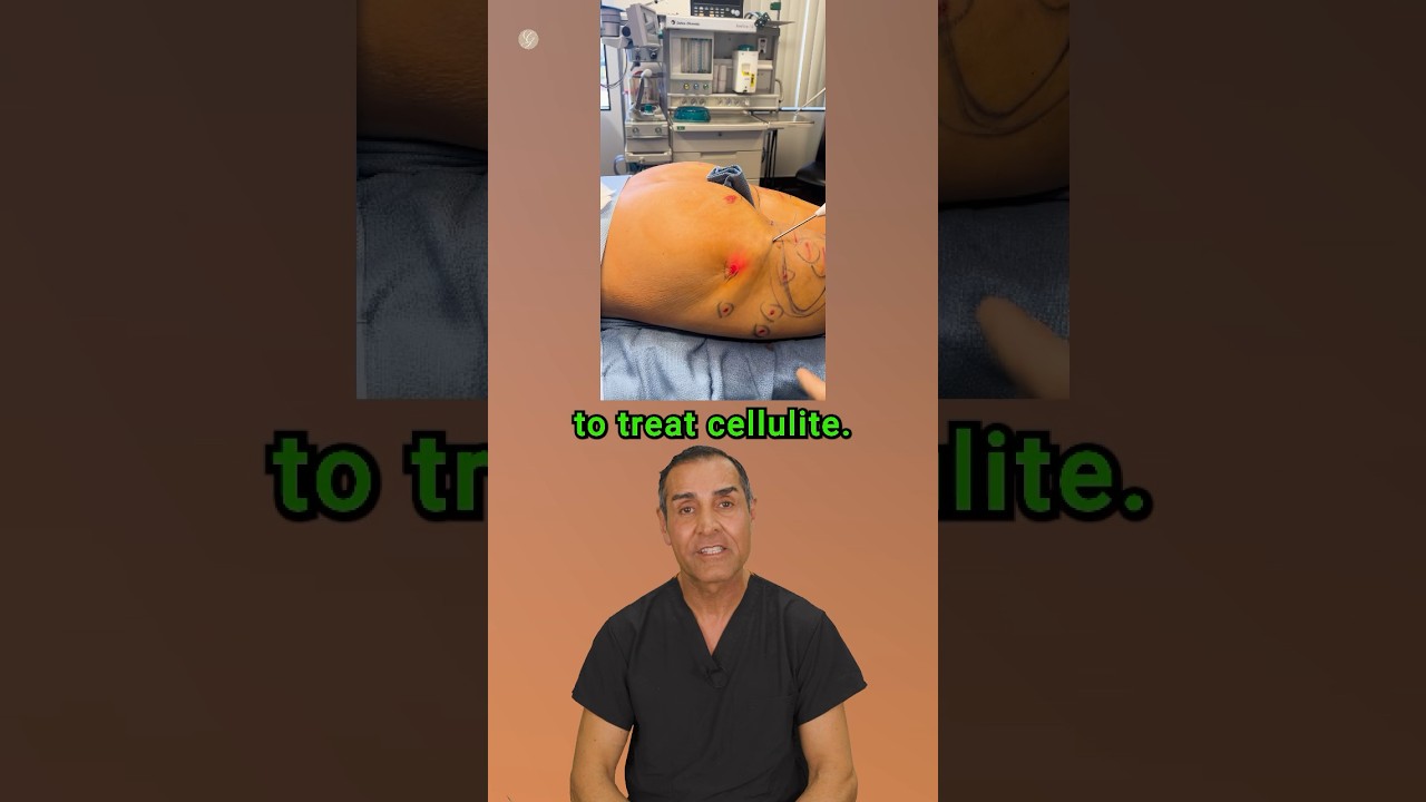 Aveli | Cellulite Treatment #cellulite