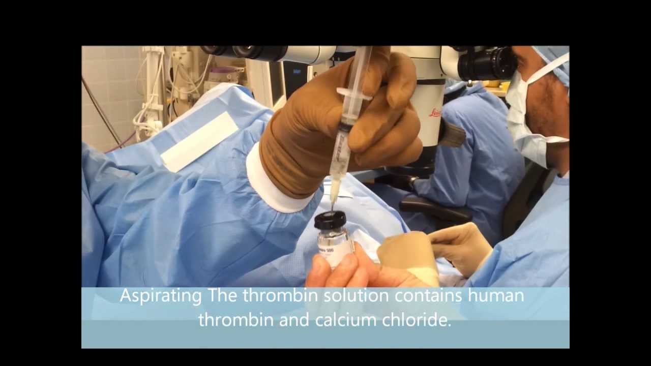 Fibrin Glue (TISSEEL) Preparation