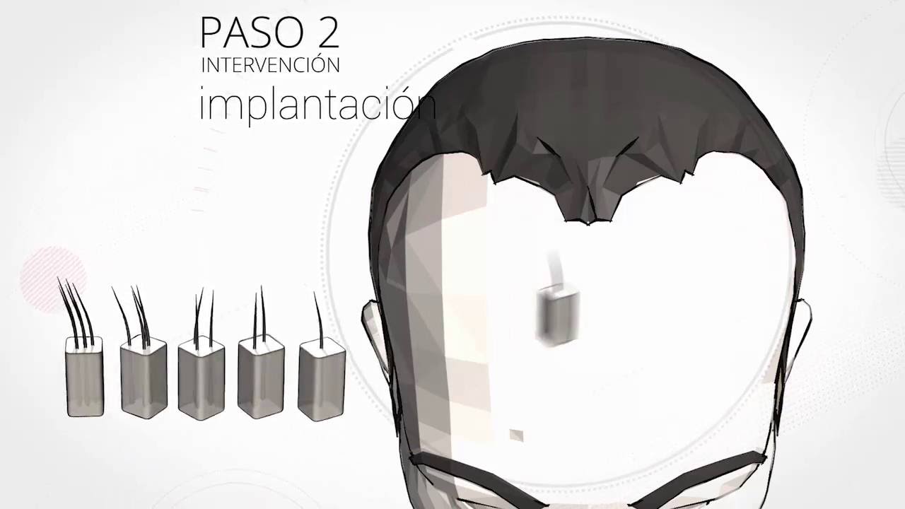 Microinjerto: Proceso paso a paso de este implante de pelo | Svenson España