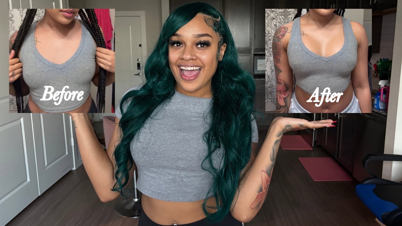 MY BREAST AUGMENTATION JOURNEY (+ first week of recovery) 😱🍒