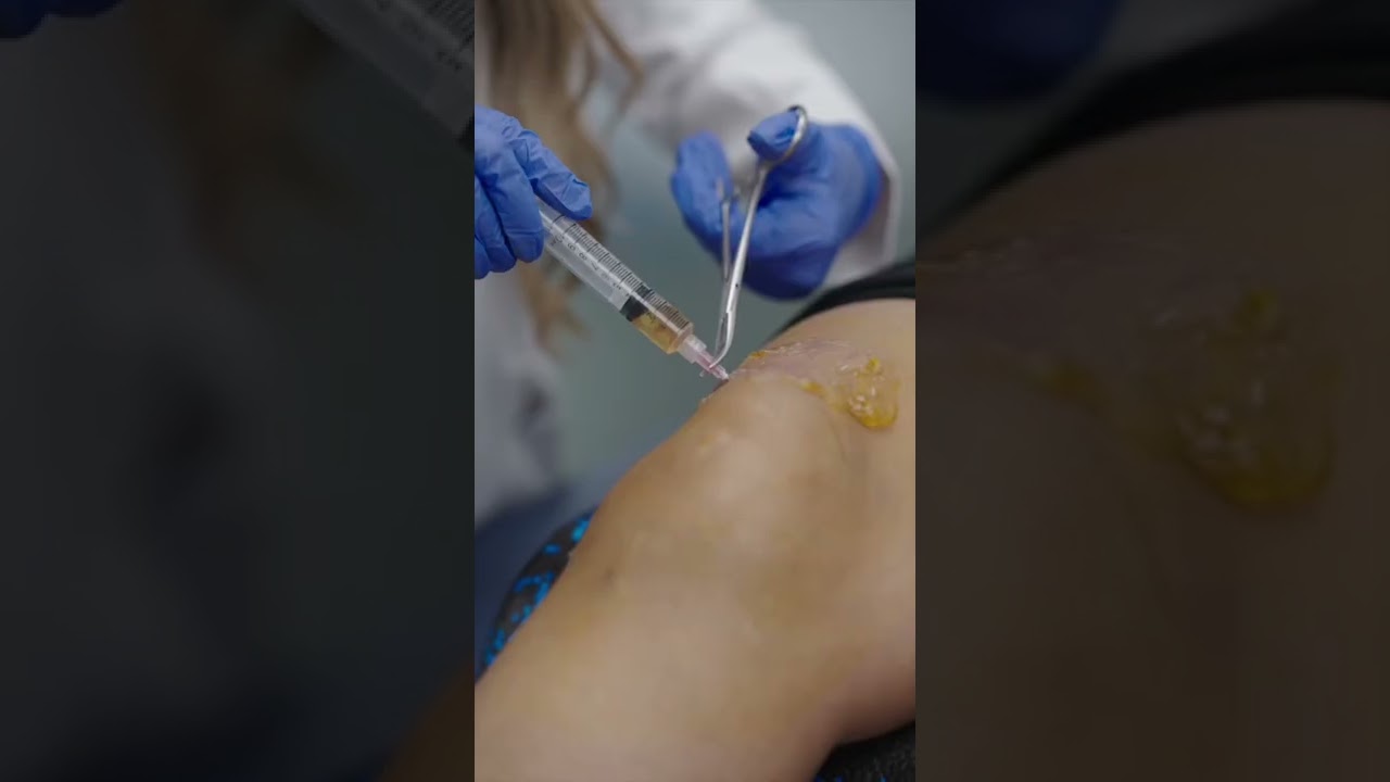 Knee Joint Aspiration and Injection with Ultrasound Guidance