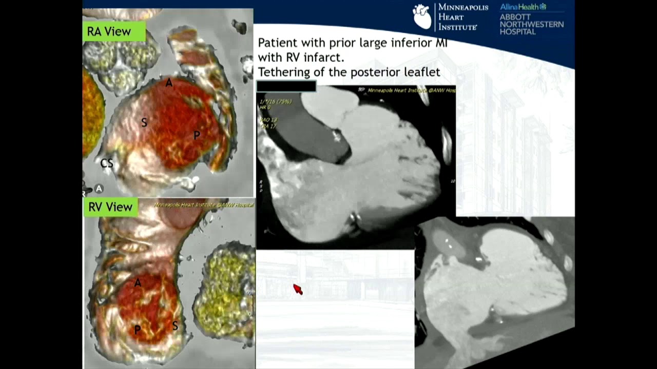 CVI 2019_Friday 7/19_ Innovations in Structural Heart Therapy_Jo&atilde;o Cavalcante, MD