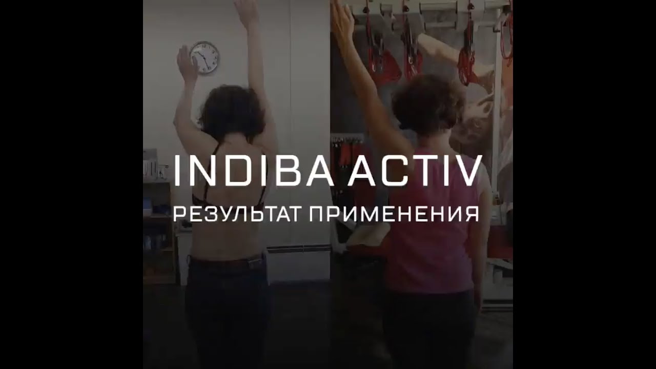 INDIBA и синдром замороженного плеча: результат применения