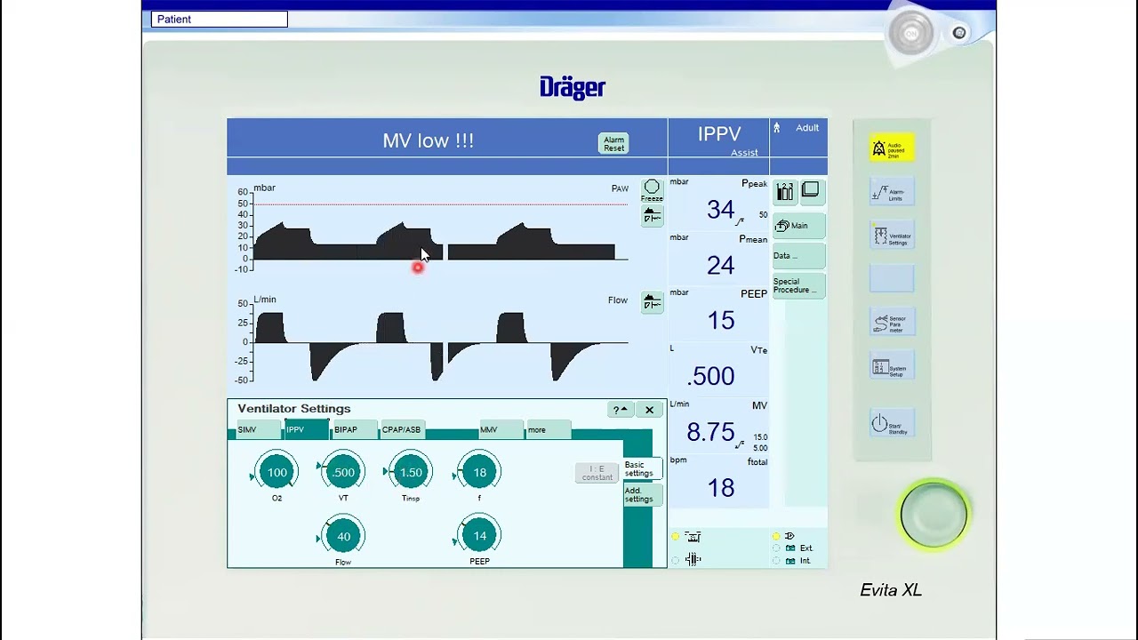 Ventilator Strategies to Improve Oxygenation