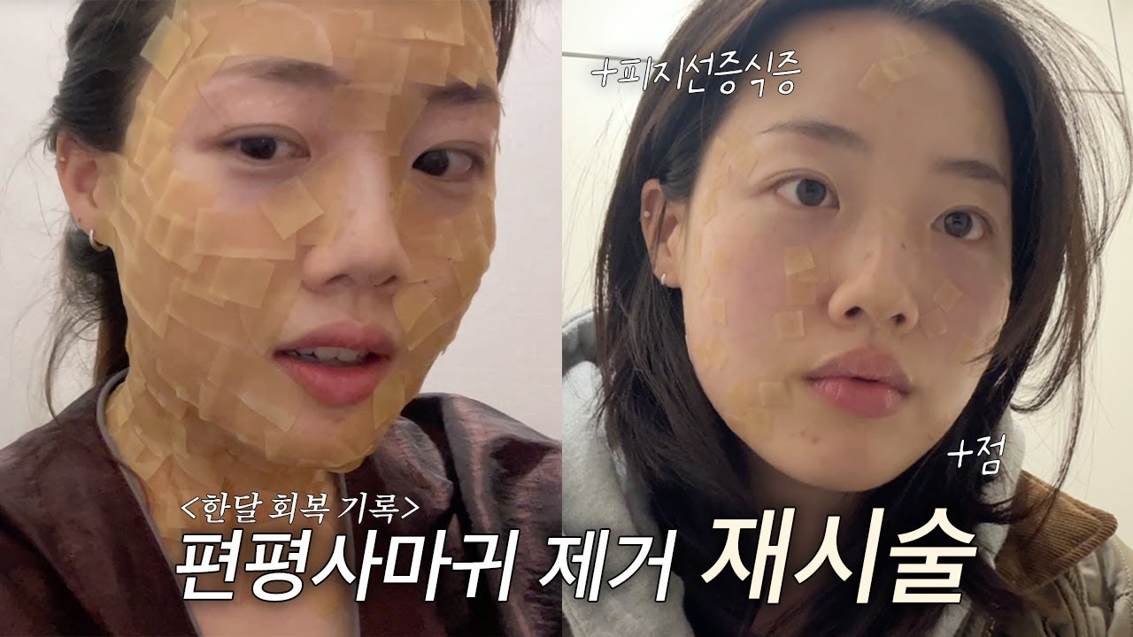 더 찐하게 돌아온 편평사마귀 전문 유튜바(?)