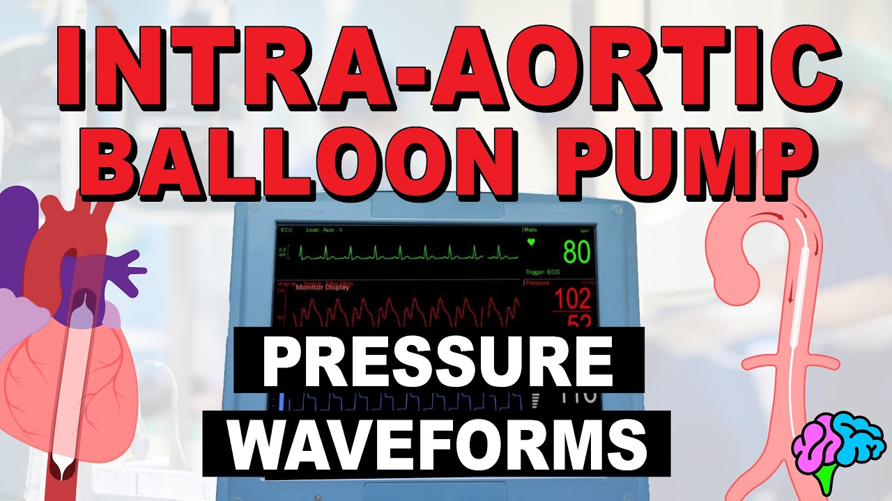 IABP Waveforms & Pressures EXPLAINED