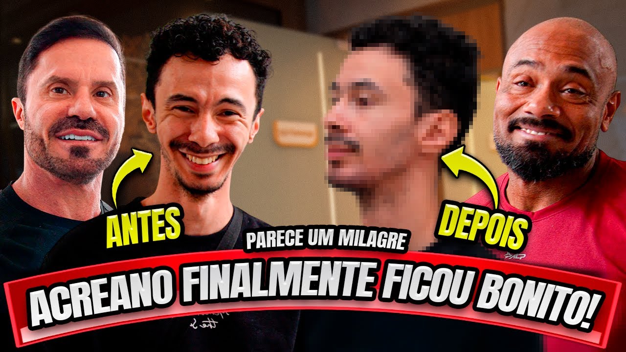 ACREANO FEZ HARMONIZAÇÃO FACIAL - PARECE UM MILAGRE! ELE FICOU BONITO!