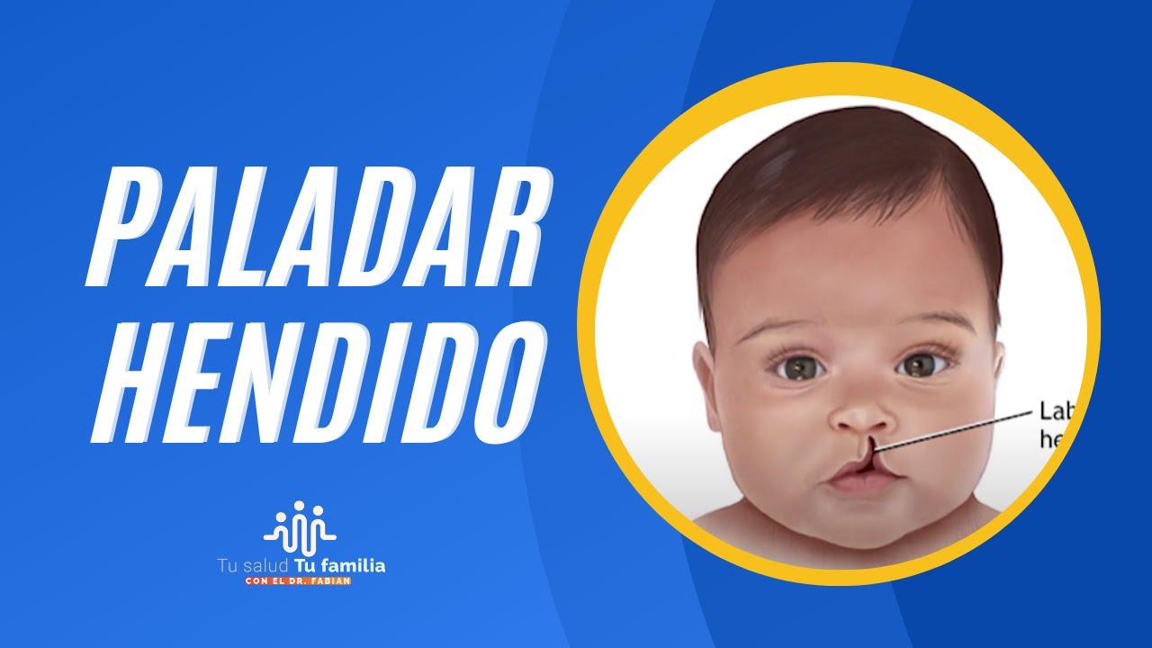 PALADAR HENDIDO - TU SALUD TU FAMILIA