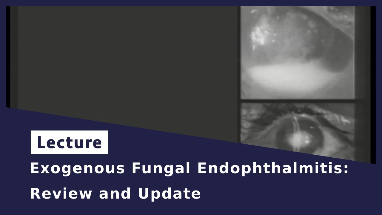 Exogenous Fungal Endophthalmitis :Review and Update