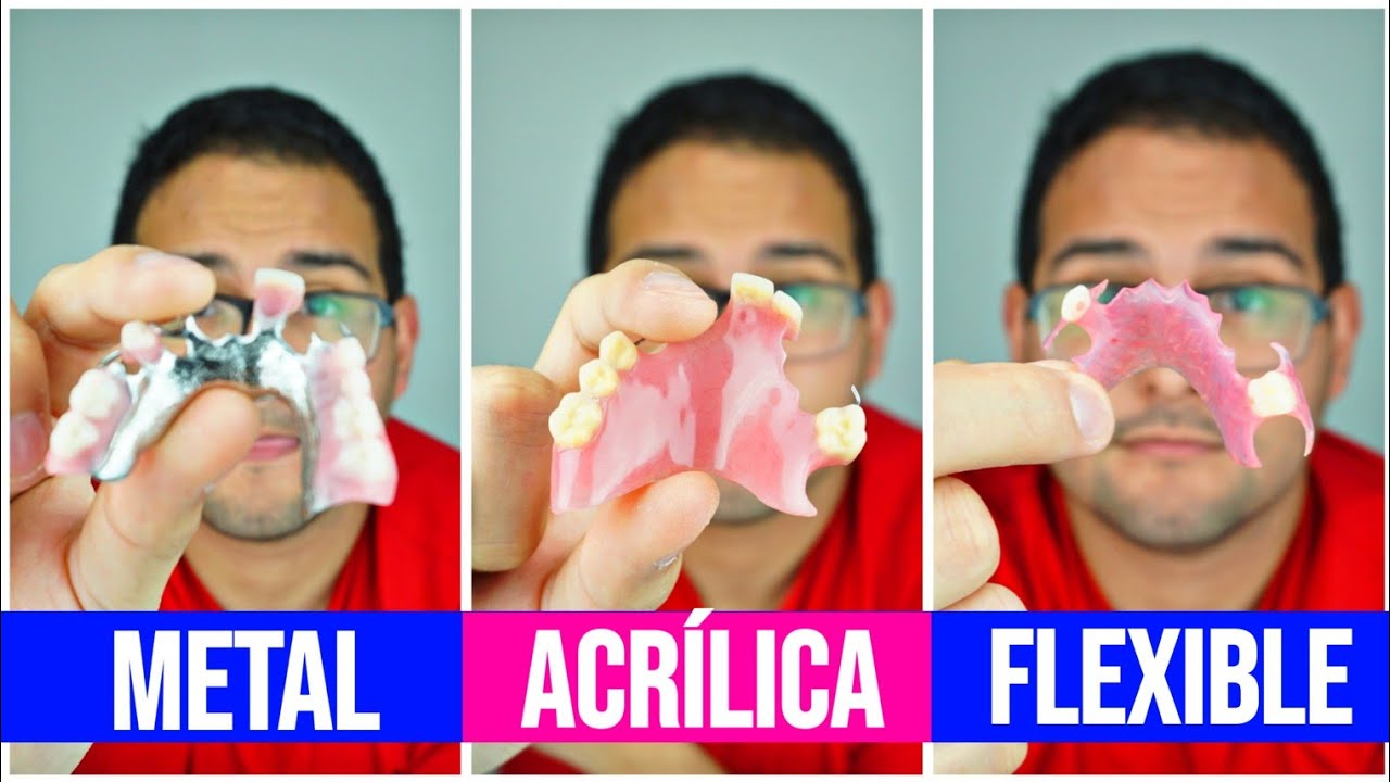 PRÓTESIS DENTAL REMOVIBLE: ¿Cuanto Cuestan en 2018🤑? ¿Cual es la mejor opción😎?