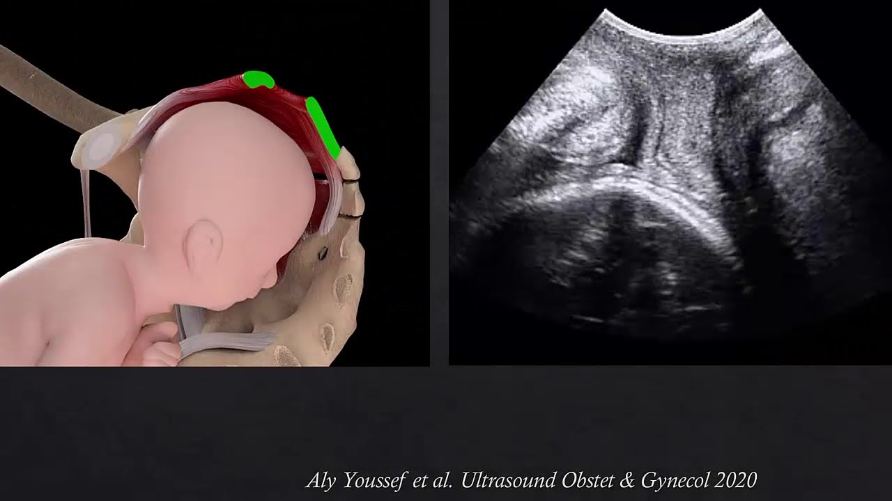 New #UOGJournal video abstract: transperineal ultrasound assessment of maternal pelvic floor at term