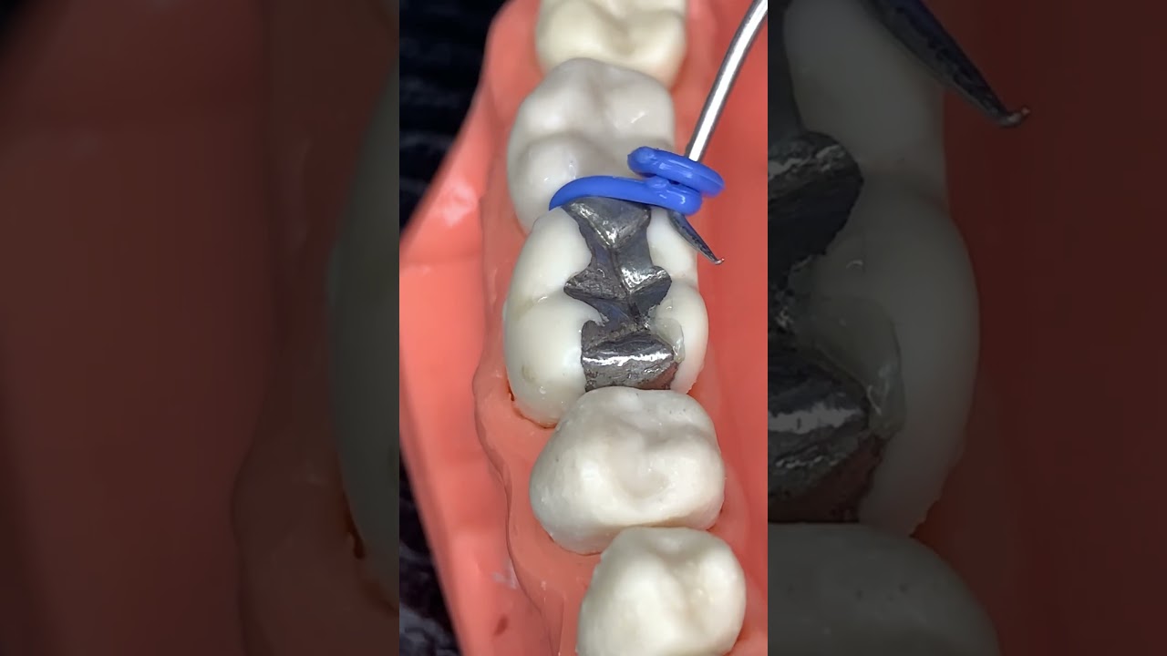 🔥DENTAL SPACERS🔥