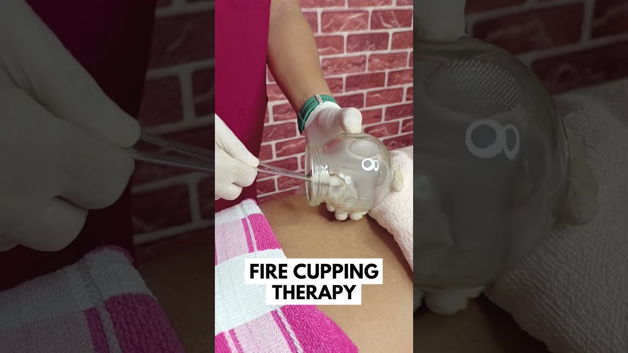 CUPPING THERAPY #hijamacupping  #cuppingtherapy