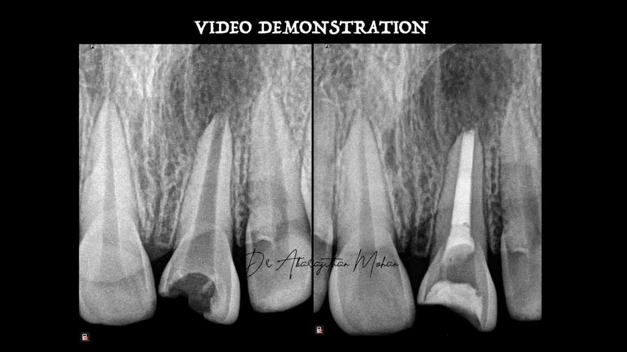 NEW SIMPLIFIED APEXIFICATION TECHNIQUE DEMONSTRATION