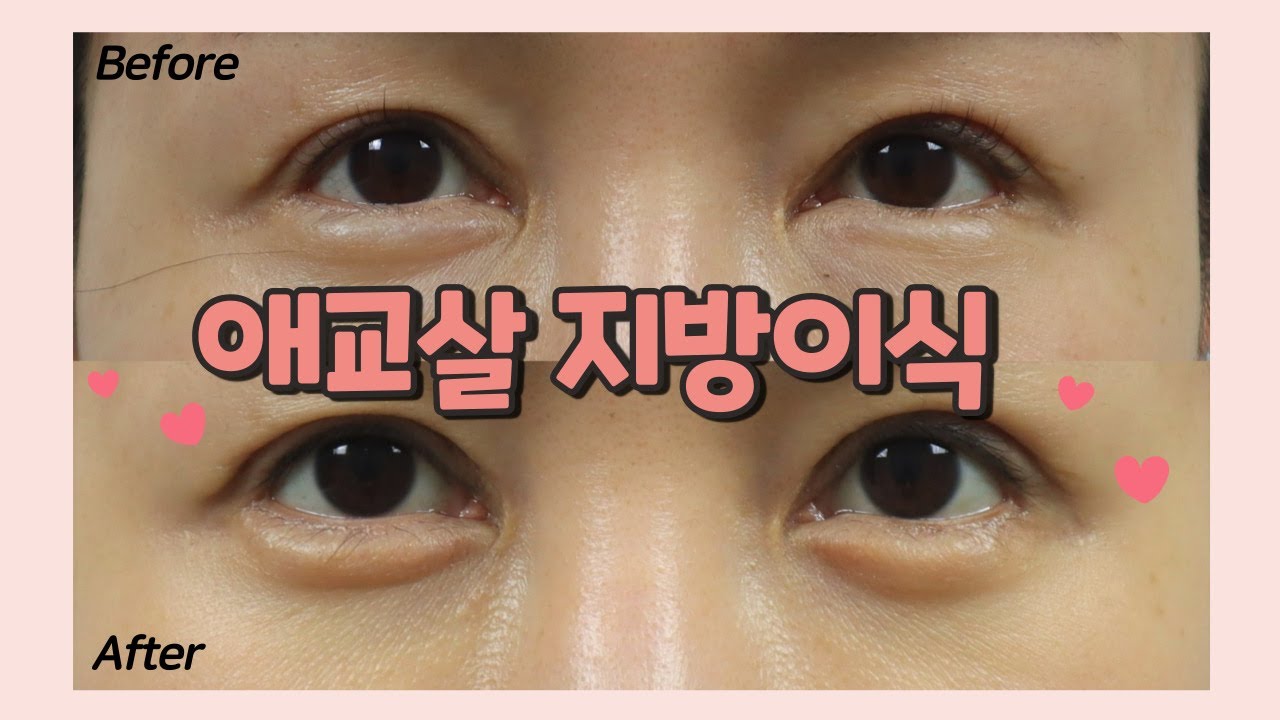 [애교살 지방이식] 또렷하고 선명한 애교라인을 갖고 싶다면!