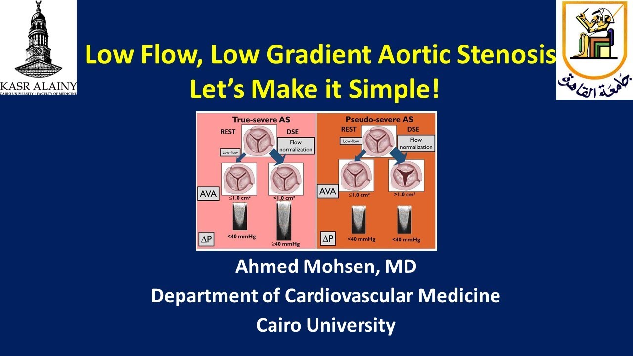 Low Flow, Low gradient Aortic stenosis ;Let's make it simple