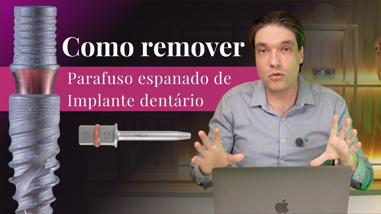 Como remover parafuso espanado em implante dentário? Retriever da Neodent