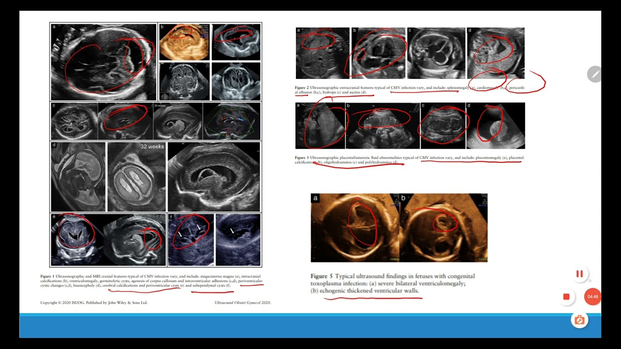 Congenital TORCH infection  in Pregnancy 