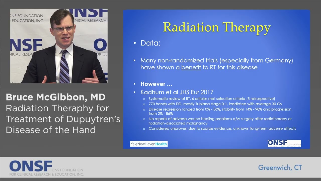 Bruce McGibbon, MD - Radiation Therapy for Treatment of Dupuytren's Disease of the Hand