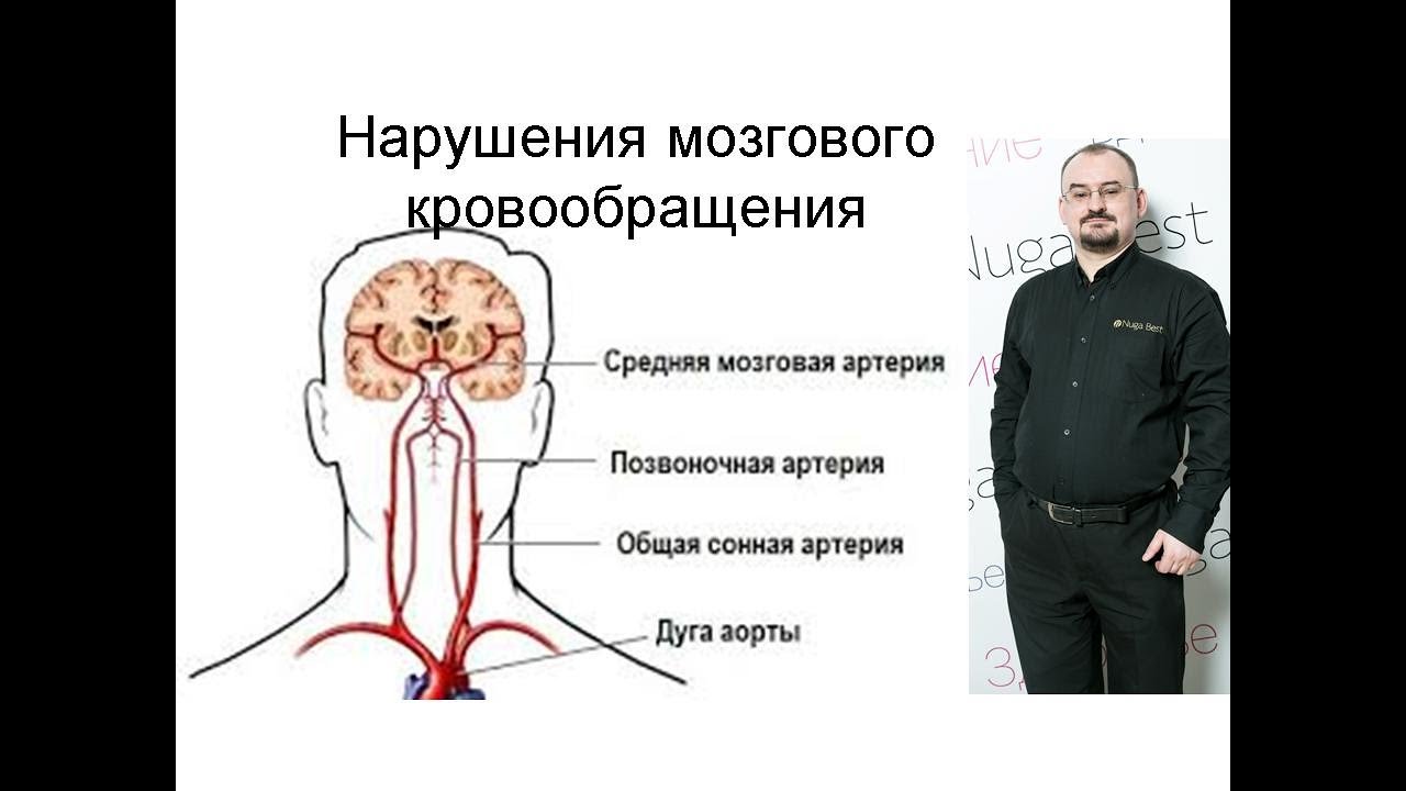 Нарушения мозгового кровообращения.