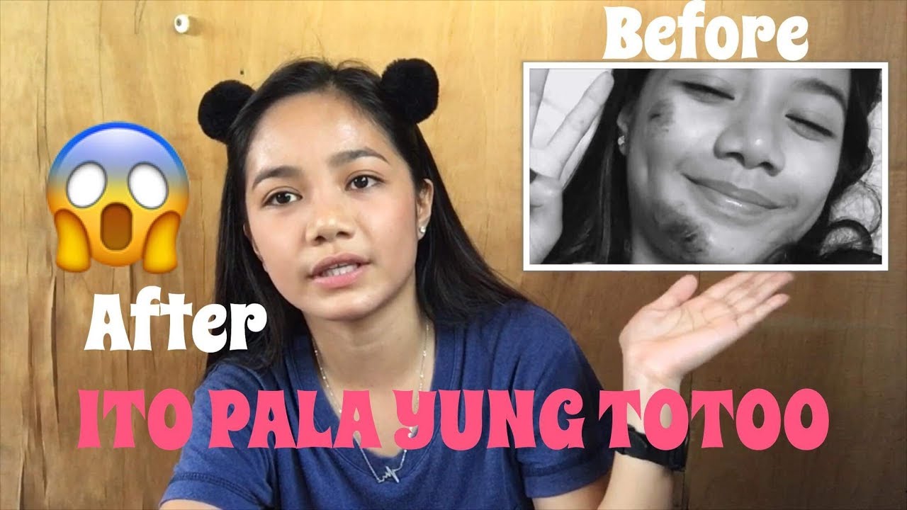 HOW TO REMOVE YOUR SCARS/PEKLAT (naaksidente si mikee?)  | MIKEE CONGE